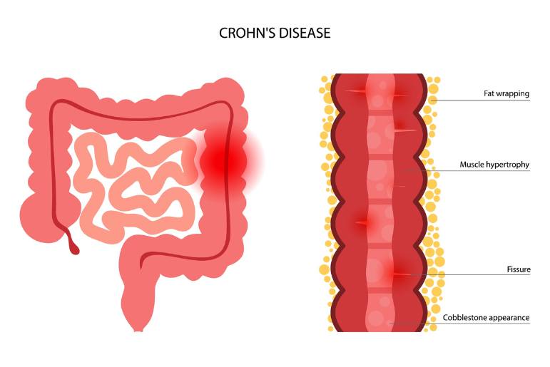 Νόσος Crohn