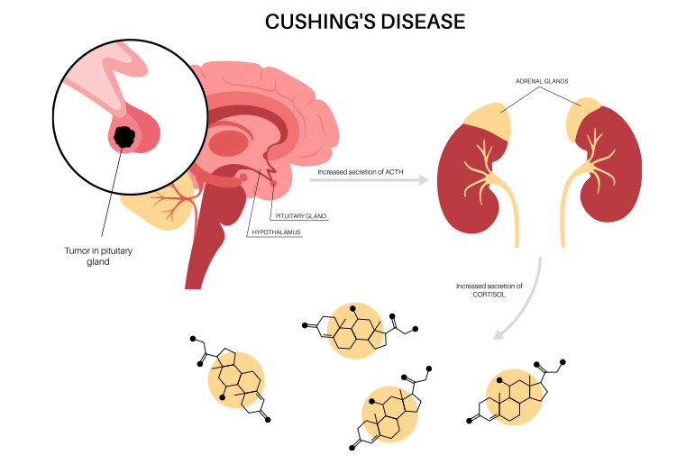 cushing's disease